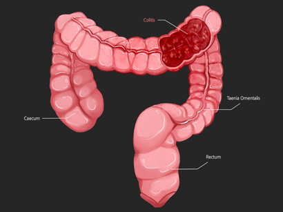 Colon Cancer