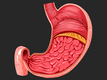 Gastric bypass (Roux-en-Y gastric bypass)