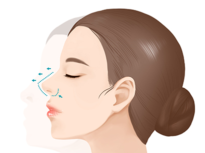 Rhinoplasty