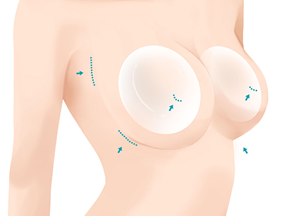 Breast Augmentation with Implants