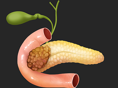 Pancreatic Cancer