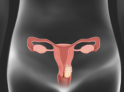 Cervical Cancer
