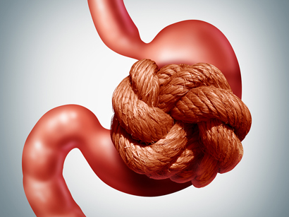 Gastric sleeve (Endoscopic sleeve gastroplasty)