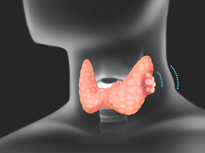 Thyroid Cancer