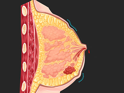 Breast Cancer