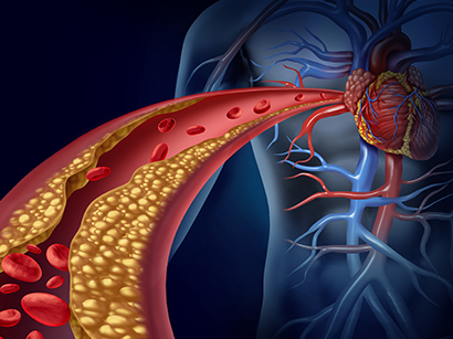 Coronary Artery Disease (CAD)