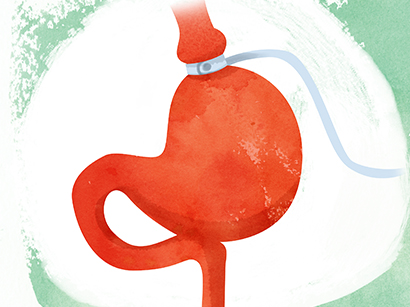 Gastric band surgery (Lap band, Adjustable gastric banding)