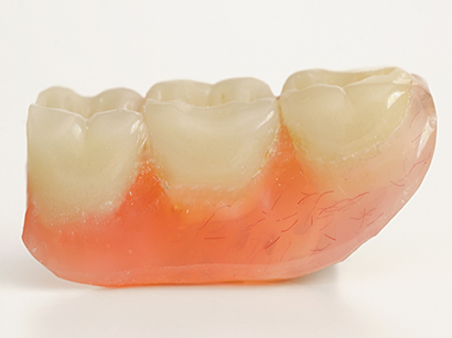 Dental bridge